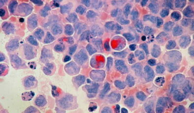 Google ve Yale’in yapay zeka modelinden kansere yönelik keşif