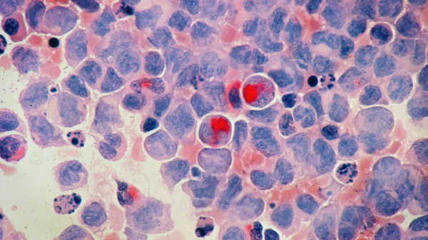 Google ve Yale’in yapay zeka modelinden kansere yönelik keşif