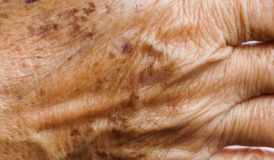 Günde 1 kez sürün, yaşlılık lekelerini götürün…