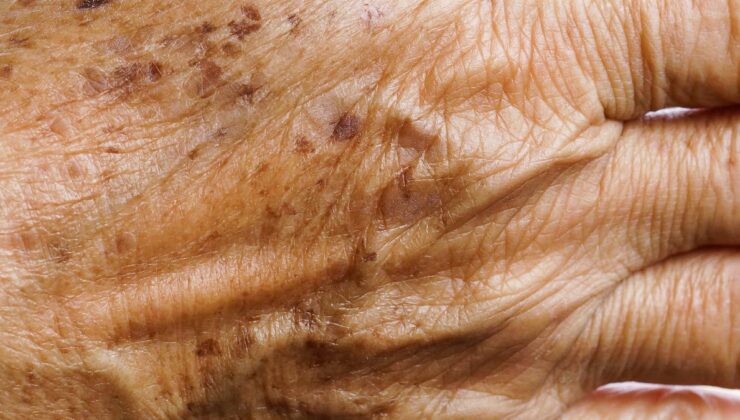 Günde 1 kez sürün, yaşlılık lekelerini götürün…