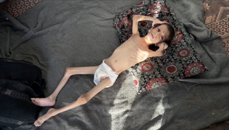 İsrail’in kıtlığa sürüklediği 10 yaşındaki Nafız kemik yığınına dönüştü