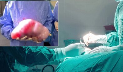 Karnındaki şişlik ‘kilo’ sanıldı, diyete başladı: 5 kiloluk kitle çıkarıldı!