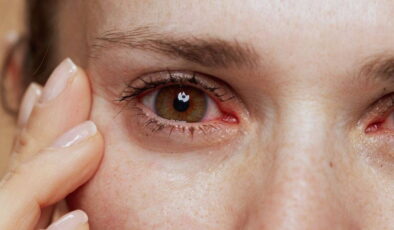 Kışla birlikte gelen göz enfeksiyonlarına dikkat