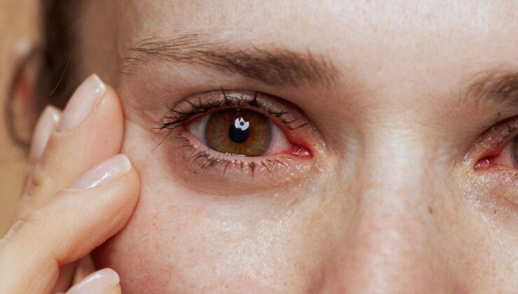 Kışla birlikte gelen göz enfeksiyonlarına dikkat