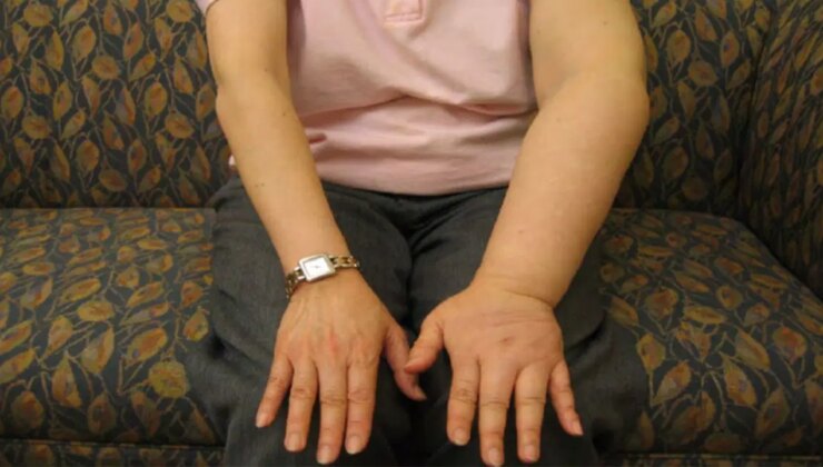 Meme kanseri sonrası sessiz tehlike: Lenfödem