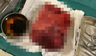 Nefes darlığı şikayeti ile hastaneye gitti, göğsünden 3 kilogramlık tümör çıktı