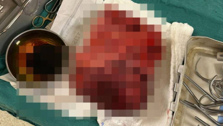 Nefes darlığı şikayeti ile hastaneye gitti, göğsünden 3 kilogramlık tümör çıktı