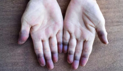 Sigara içenler dikkat: Bu hastalık sinsi ilerliyor, doku kaybına neden oluyor