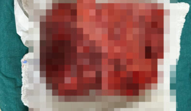 Sivas’ta nefes darlığı şikayetiyle hastaneye gitti, göğsünden 3 kilogramlık tümör çıktı