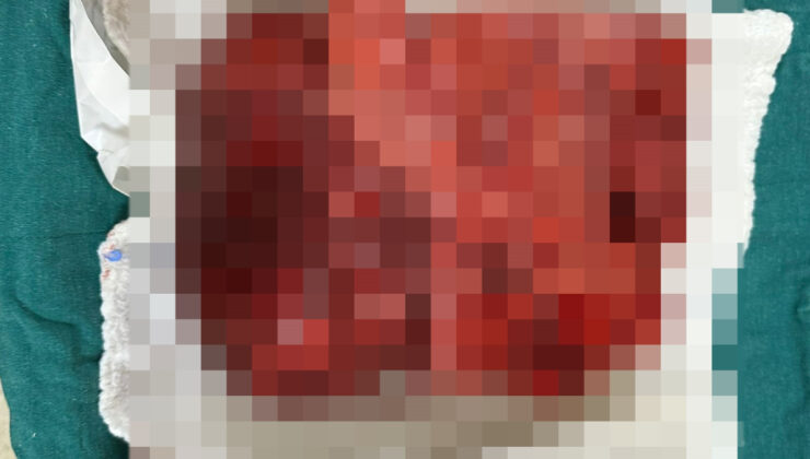 Sivas’ta nefes darlığı şikayetiyle hastaneye gitti, göğsünden 3 kilogramlık tümör çıktı