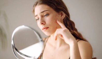 Sivilce izlerini yok ediyor, pürüzsüz bir cilde sahip olmayı sağlıyor : Akne izlerine karşı evinizde uygulayabileceğiniz 7 doğal çözüm