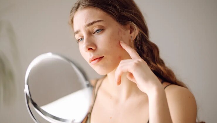 Sivilce izlerini yok ediyor, pürüzsüz bir cilde sahip olmayı sağlıyor : Akne izlerine karşı evinizde uygulayabileceğiniz 7 doğal çözüm