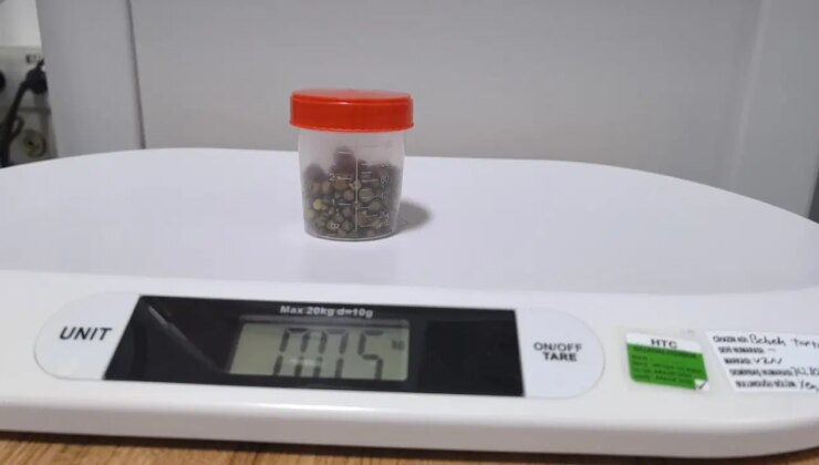 Bursa’da 77 yaşındaki kadının safra kesesinden 213 tane taş çıkarıldı