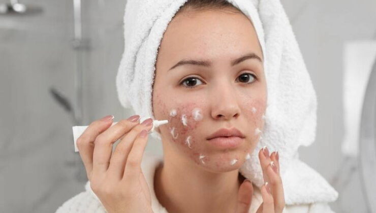 Cilt sorunlarının gizli tetikleyicileri:  Akneye yol açan 10 alışkanlık