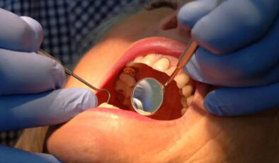 Diş minesini onaran yeni jel: Çürüklerin sonu mu geliyor?