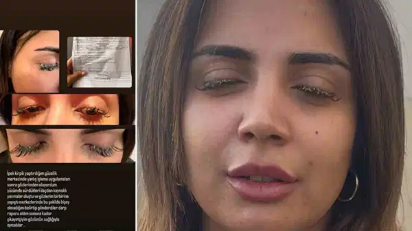 Güzellik merkezinde dehşet… Kirpiklerini yaptırmaya gitti kimyasal gözünü yaktı!