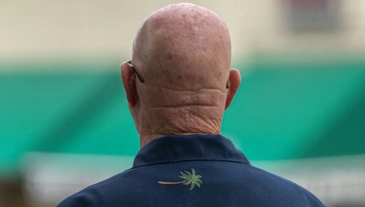 İnsanların inanmayı seçtiği 3 saç dökülme sebebi efsanesi