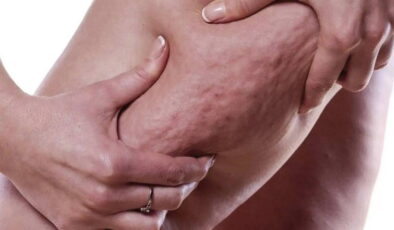 Kadınların sessiz çığlığı: Lipödem