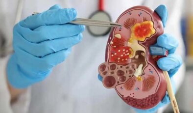 Uzmandan uyarı: Çocuklarda böbrek taşı riski artıyor