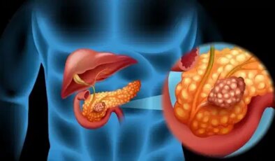 Uzmanı pankreas kanserine karşı uyardı: ‘Artan sigara kullanımı riski yükseltiyor’