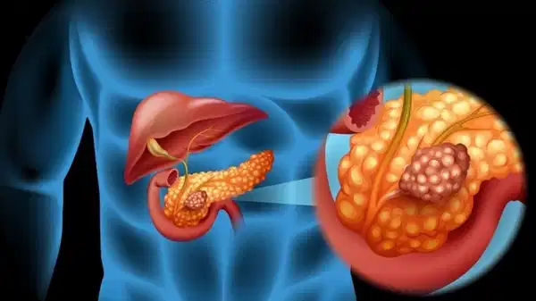 Uzmanı pankreas kanserine karşı uyardı: ‘Artan sigara kullanımı riski yükseltiyor’