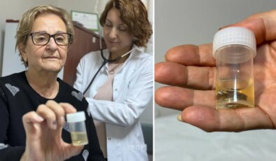 Hapı ‘alüminyum kabıyla’ yuttu: Akciğerinden 4 yıl sonra çıkarıldı