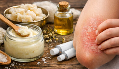 Kuyruk yağı kremi egzama tedavisinde sorun oluşturabilir