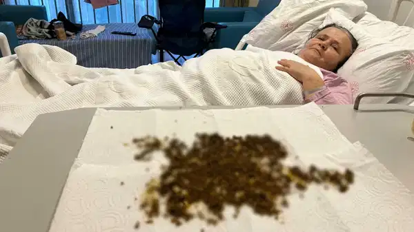 Manisa’da ‘yapay zeka’lı nadir ameliyat: Safra kesesinden 20 binden fazla taş çıkarıldı!