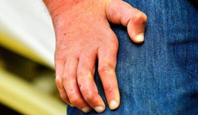 Romanya ve Hırvatistan’da 40 yılın ardından cüzzam vakaları görüldü