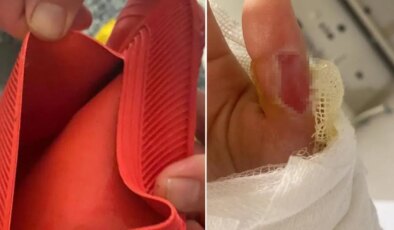 Sıcak su torbası patladı, vücudunun yüzde 25’i yandı