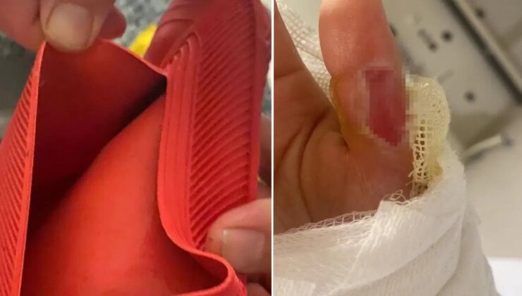 Sıcak su torbası patladı, vücudunun yüzde 25’i yandı