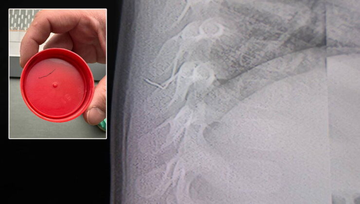 ‘8 yaşına kadar bekleyin’ dediler: Bebeğin akciğerinden çıkan cisim şaşırttı!