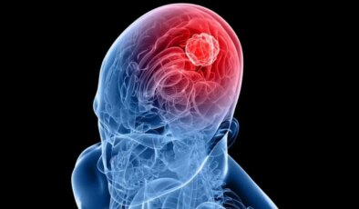 Bilim insanlarından umut veren yöntem: Burun spreyiyle ölümcül beyin tümörü tedavisi