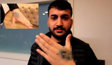 Dövme sildirmek isterken kabusu yaşadı: Elindeki dokular öldü