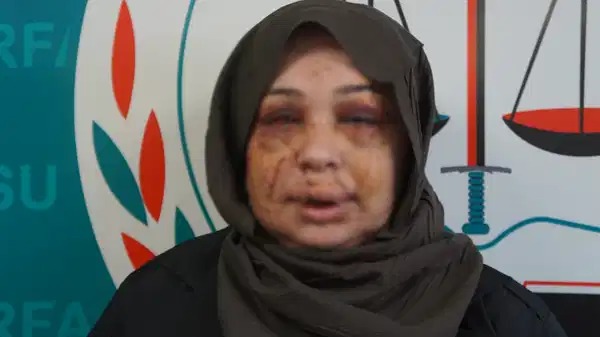 Polis eşi tarafından darbedildiği iddiasıyla şikayetçi oldu: ‘Vicdanı olan herkesten yardım istiyorum’