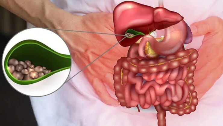 Safra kesesi ameliyatlarının artmasının nedeni zayıflama iğneleri olabilir