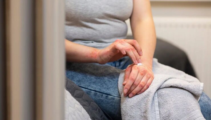 Sıcak su cildin koruyucu bariyerini eritiyor: Kış egzamasının en büyük tetikleyicisi…