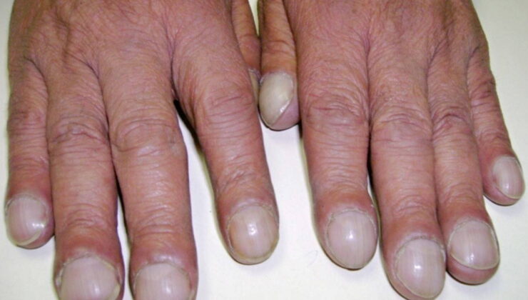 Tırnaklarınız ipucu veriyor olabilir: Akciğer kanserinde “çomak parmak” belirtisi