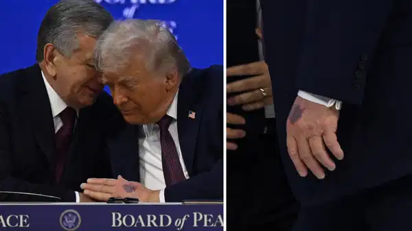 Trump’ın elindeki morluğun nedeni belli oldu