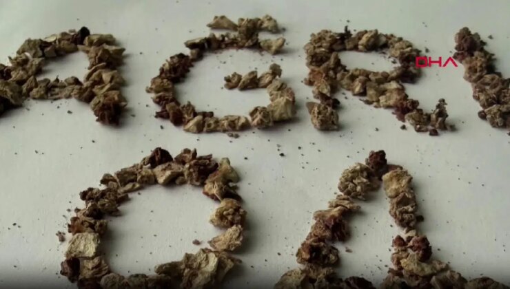 21 kez operasyon geçiren hastadan 295 böbrek taşı çıkarıldı