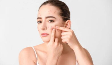 Cilt sağlığında göz ardı edilen gerçek: Sivilce oluşumunu tetikleyen 5 besin