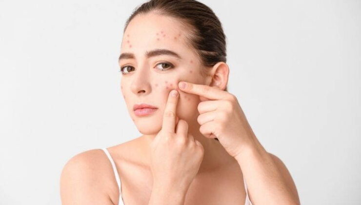 Cilt sağlığında göz ardı edilen gerçek: Sivilce oluşumunu tetikleyen 5 besin