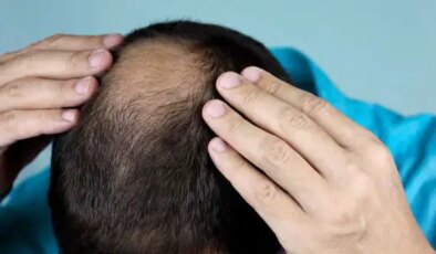 Bilim insanları açıklıyor: Kellik gerçekten genetik mi?