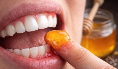 Doğal ilacı çıktı! Diş etlerine bal sürmek dişçiden kurtarıyor…