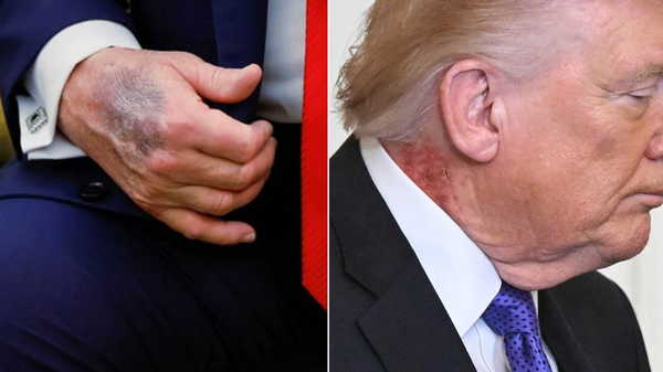 Morluğun ardından kızarıklık… Trump’ın doktorundan açıklama geldi