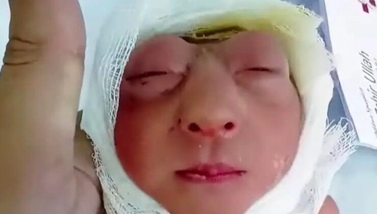 Kafatası oluşmadan doğdu: Bangladeş’te “anensefali” vakası