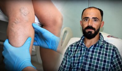 Dünyada sadece birkaç tane vaka var: Sedef hastalığı nedeniyle atardamarı yırtıldı!