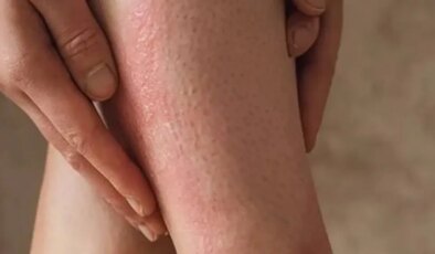 ‘Çilek bacak’ görünümüne dikkat: Yanlış peeling cildi tahriş edebilir
