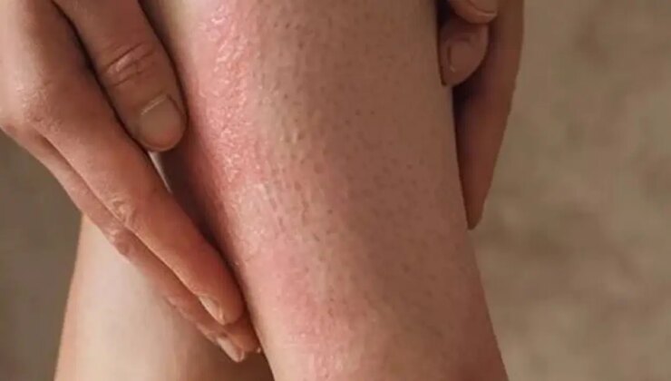 ‘Çilek bacak’ görünümüne dikkat: Yanlış peeling cildi tahriş edebilir